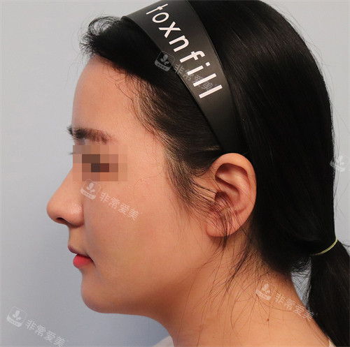 韓國Toxnfill調(diào)整后面部輪廓 韓國Toxnfill調(diào)整后面部輪廓