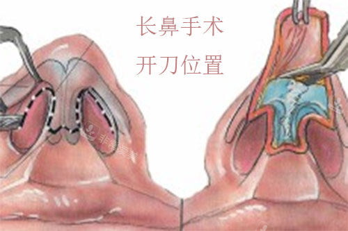 长鼻矫正手术开刀位置图解