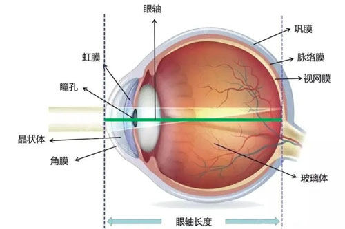 近视术