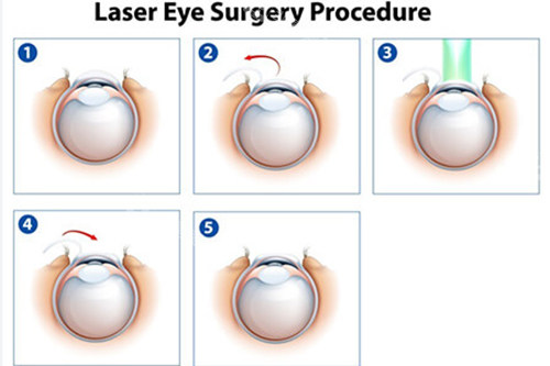 近视矫正飞秒手术过程