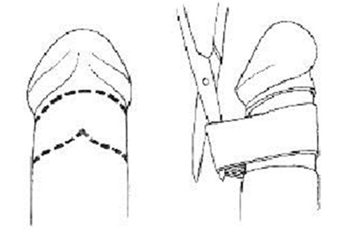 包皮环切术的手术步骤
