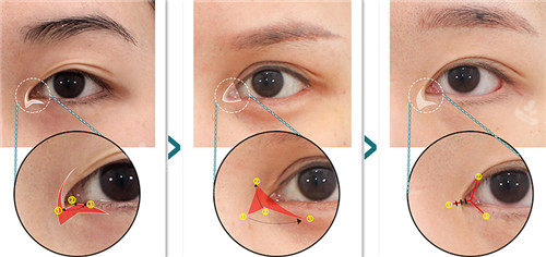 韩国喜可整形眼角手术细节图
