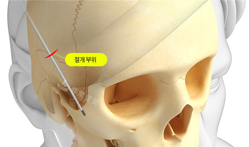 韩国雅阁整形外科颧骨整形图示