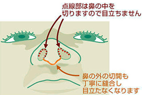鼻孔缩小手术过程图解