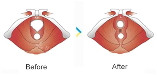 处女膜修复前后