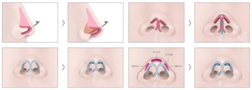 鼻修復(fù)過程圖