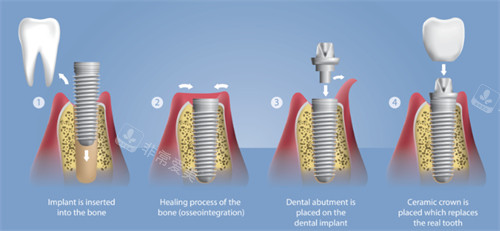 种植牙过程