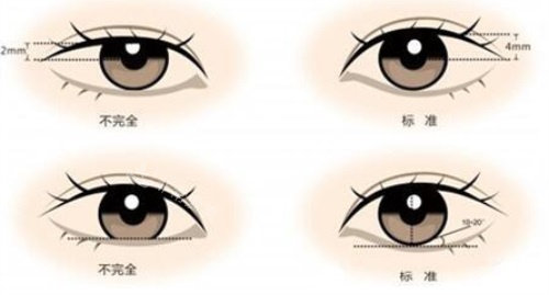 眼整形示意圖 眼整形示意圖