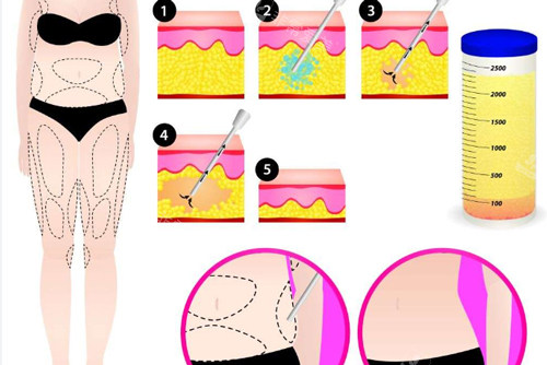 吸脂手术过程图解