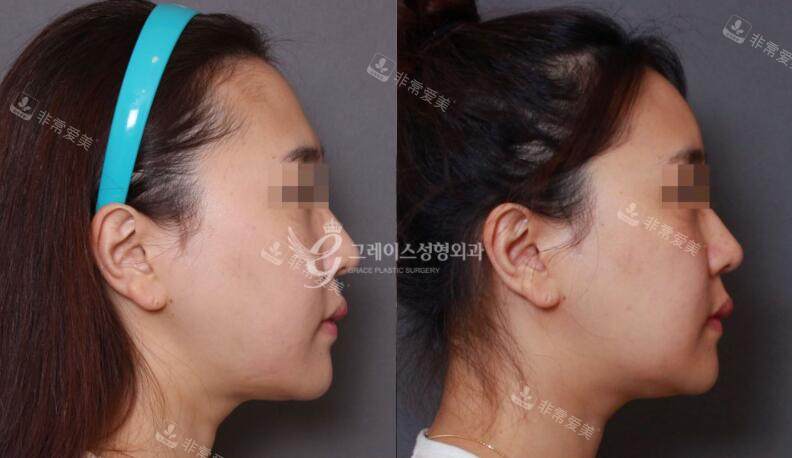 韩国格瑞丝整形外科额头缩小术前后对比照片