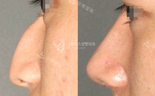 韩国格瑞丝整形外科隆鼻前后对比照片