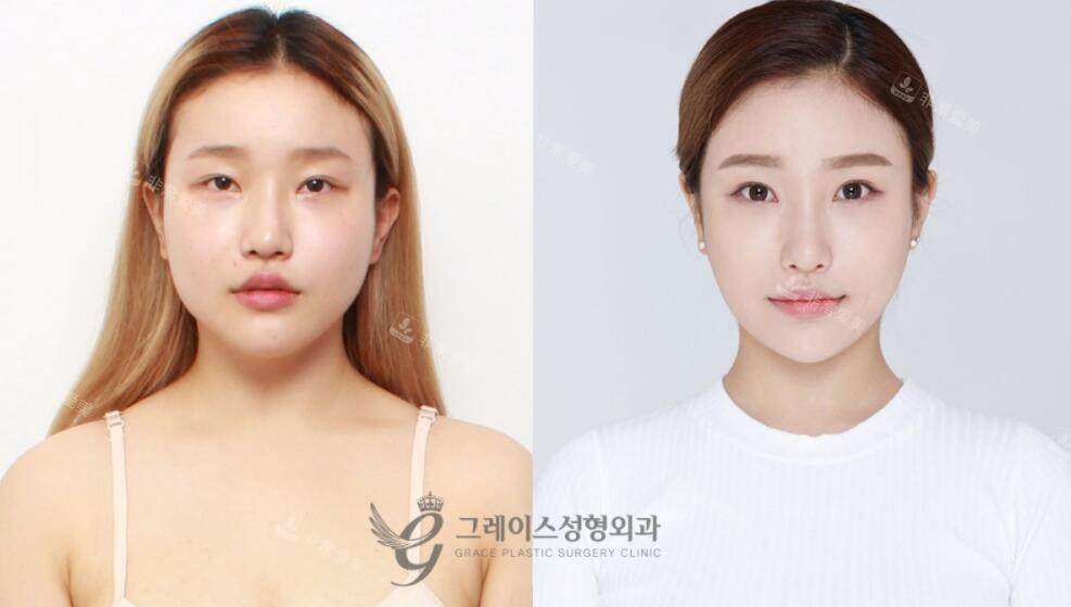 韩国格瑞丝整形外科面部轮廓手术前后照片