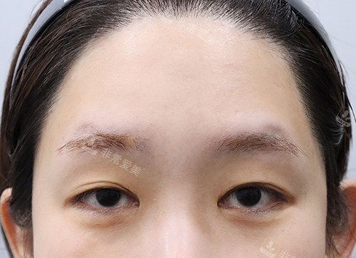 額頭提升手術以前