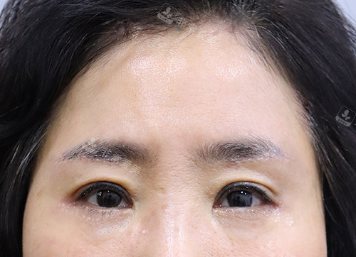 額頭提升+眉底提升+下眼瞼手術(shù)后