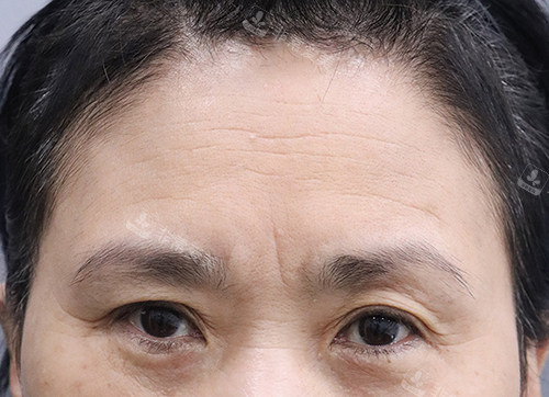 額頭提升手術(shù)前 額頭提升手術(shù)前