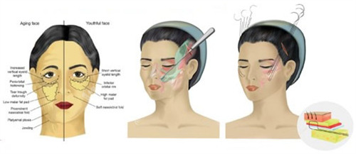 面部埋线提升手术过程
