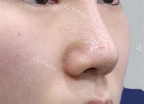 韓國玲克整形隆鼻手術(shù)后 韓國玲克整形隆鼻手術(shù)后