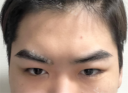 韓國玲克整形面部提升手術(shù)前 韓國玲克整形面部提升手術(shù)前