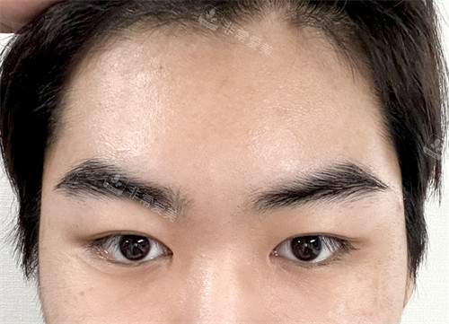 韓國玲克整形面部提升手術(shù)后 韓國玲克整形面部提升手術(shù)后