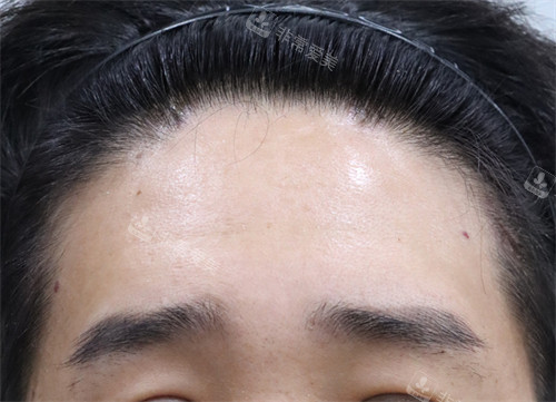 韓國玲克整形面部提升手術-術后 韓國玲克整形面部提升手術-術后