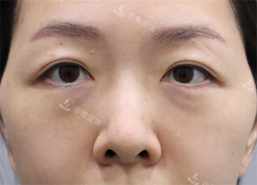 韓國(guó)玲克整形去黑眼圈手術(shù)前 韓國(guó)玲克整形去黑眼圈手術(shù)前