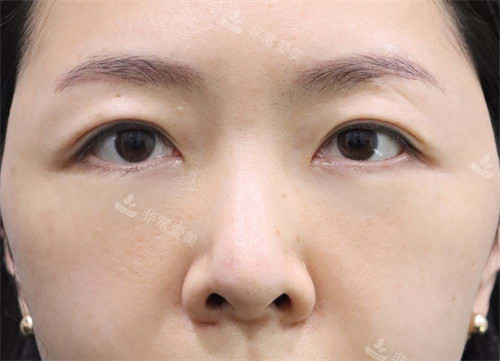 韓國(guó)玲克整形去黑眼圈手術(shù)后 韓國(guó)玲克整形去黑眼圈手術(shù)后