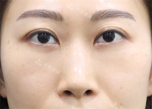 韩国玲克整形眼底脂肪重排手术后 韩国玲克整形眼底脂肪重排手术后