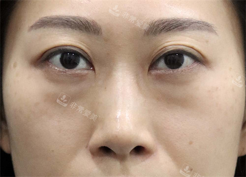 韩国玲克整形眼底脂肪重排手术前 韩国玲克整形眼底脂肪重排手术前