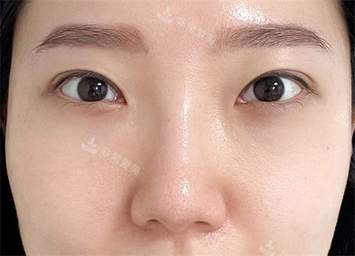 韩国玲克整形眼底脂肪重排手术-术后 韩国玲克整形眼底脂肪重排手术-术后
