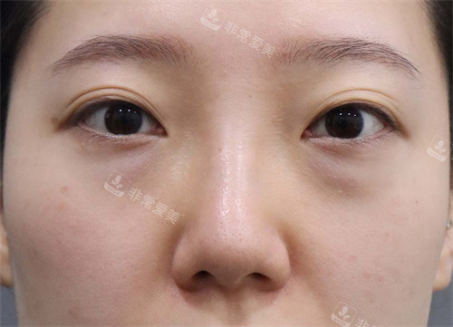韩国玲克整形眼底脂肪重排手术-术前 韩国玲克整形眼底脂肪重排手术-术前
