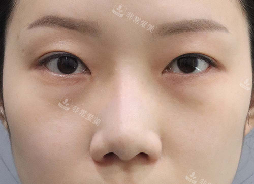 韩国玲克整形眼下脂肪重置手术前 韩国玲克整形眼下脂肪重置手术前