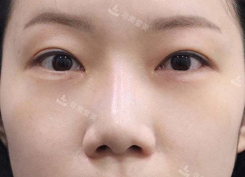 韩国玲克整形眼下脂肪重置后 韩国玲克整形眼下脂肪重置后