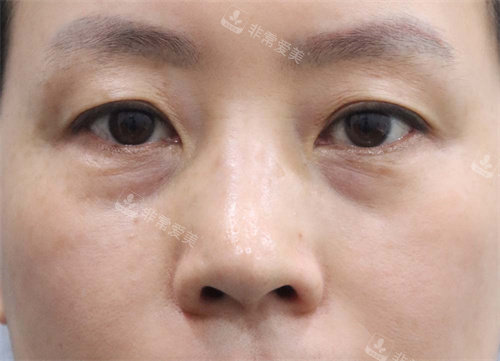 眼底脂肪重置前 眼底脂肪重置前