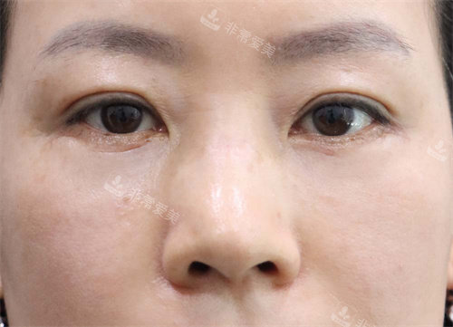 眼底脂肪重置后 眼底脂肪重置后