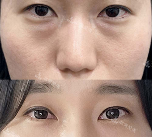 眼底脂肪重置對(duì)比 眼底脂肪重置對(duì)比