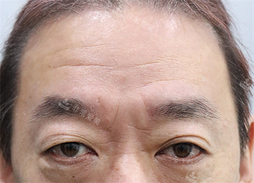額頭提升前