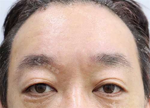 額頭提升后