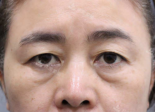 韓國(guó)玲克整形眼底脂肪重置手術(shù)前 韓國(guó)玲克整形眼底脂肪重置手術(shù)前
