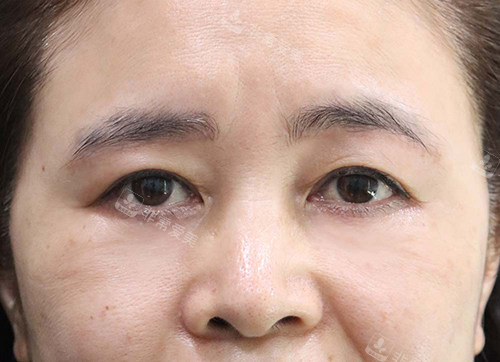 韓國(guó)玲克整形眼底脂肪重置手術(shù)后 韓國(guó)玲克整形眼底脂肪重置手術(shù)后