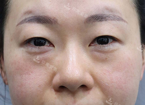 韓國(guó)玲克整形眼底脂肪重排手術(shù)前