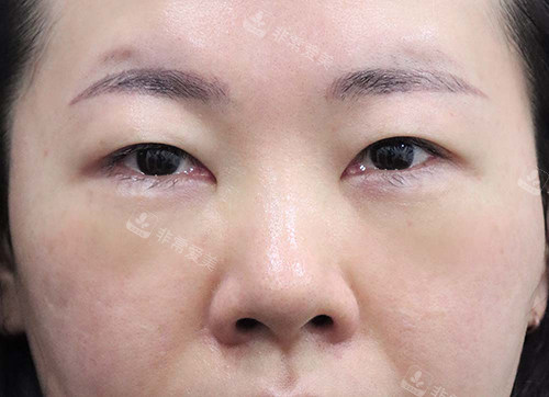 韓國(guó)玲克整形眼底脂肪重排手術(shù)后