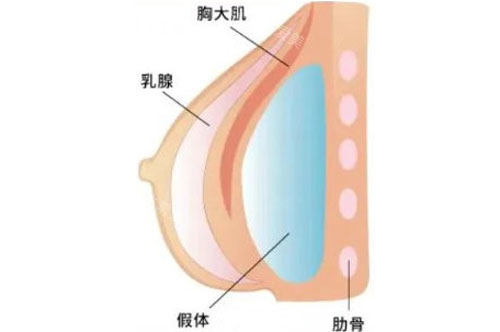 假体隆胸假体放置的层次图解