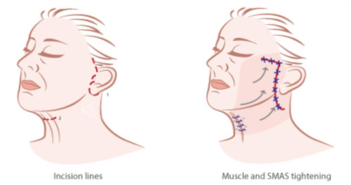 微拉美手术切口和提升方向