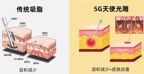 传统吸脂和5g天使光雕的区别示意图