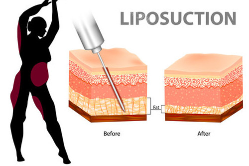 吸脂手术前后脂肪的变化