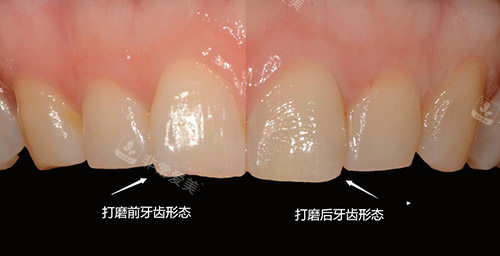 韓國(guó)三小時(shí)齒科醫(yī)院牙齒貼面打磨<span style=