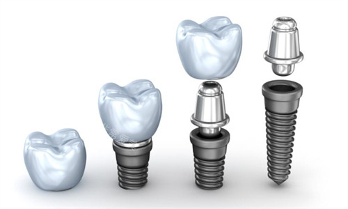 种植牙的组成部分