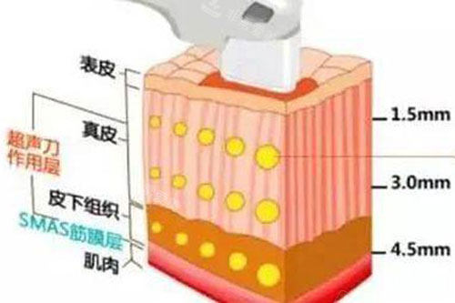 超声炮提升的原理