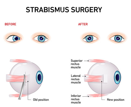 眼睛斜视的表现