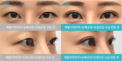 韩国来客整形外科双眼皮日记